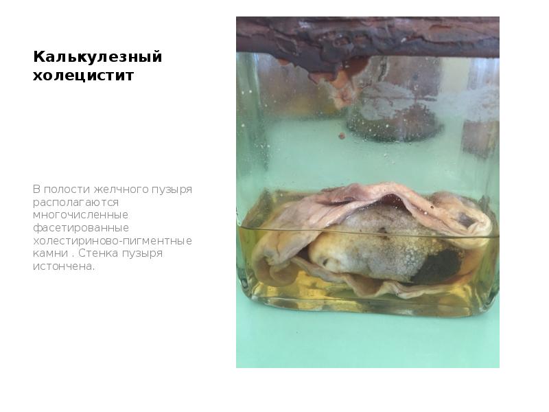 Калькулезный холецистит
В полости желчного пузыря располагаются многочисленные фасетированные холестириново-пигментные камни Калькулезный холецистит
В полости желчного пузыря располагаются многочисленные фасетированные холестириново-пигментные камни