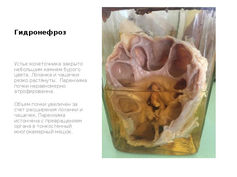 Гидронефроз
Устье мочеточника закрыто небольшим камнем бурого цвета. Лоханка и чашечки Гидронефроз
Устье мочеточника закрыто небольшим камнем бурого цвета. Лоханка и чашечки