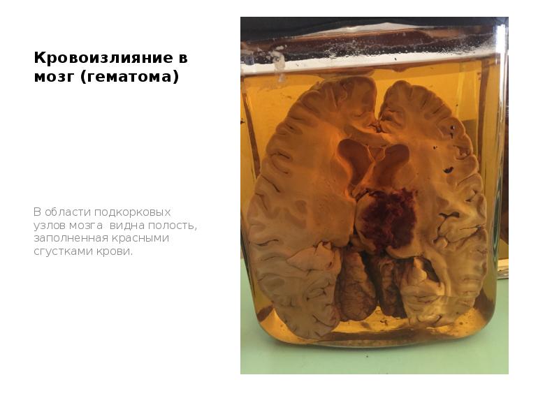 Кровоизлияние в мозг (гематома)
В области подкорковых узлов мозга видна Кровоизлияние в мозг (гематома)
В области подкорковых узлов мозга видна