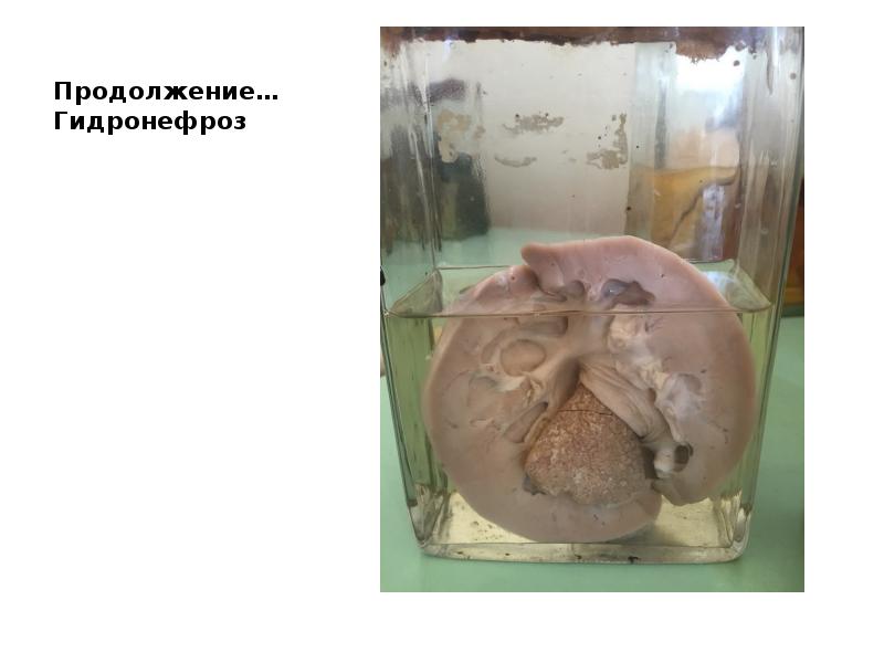 Продолжение… Гидронефроз Продолжение… Гидронефроз