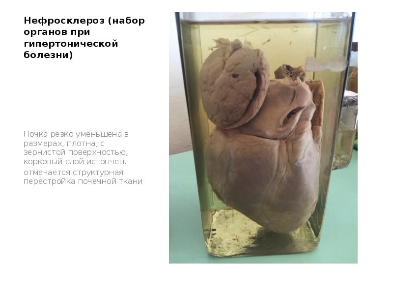 Нефросклероз (набор органов при гипертонической болезни)
Почка резко уменьшена в размерах, Нефросклероз (набор органов при гипертонической болезни)
Почка резко уменьшена в размерах,
