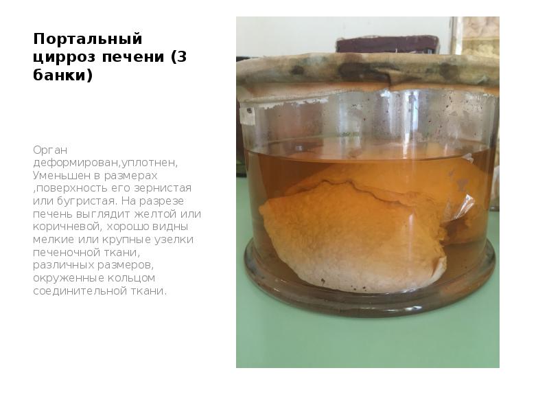 Портальный цирроз печени (3 банки)
Орган деформирован,уплотнен, Уменьшен в размерах ,поверхность Портальный цирроз печени (3 банки)
Орган деформирован,уплотнен, Уменьшен в размерах ,поверхность