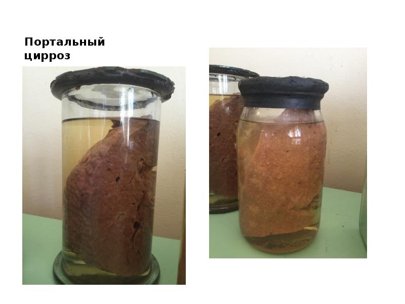 Портальный цирроз Портальный цирроз