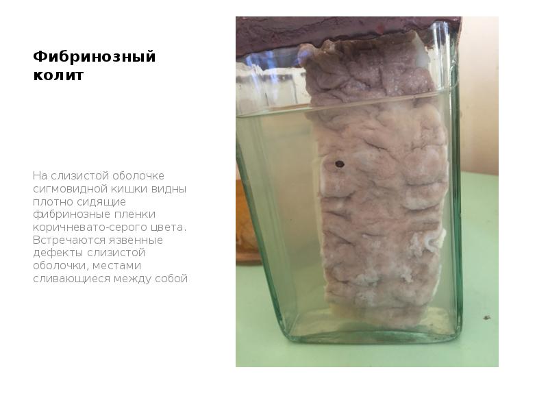 Фибринозный колит
На слизистой оболочке сигмовидной кишки видны плотно сидящие фибринозные Фибринозный колит
На слизистой оболочке сигмовидной кишки видны плотно сидящие фибринозные