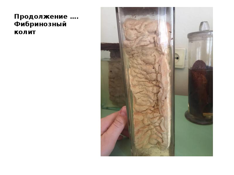 Продолжение …. Фибринозный колит Продолжение …. Фибринозный колит