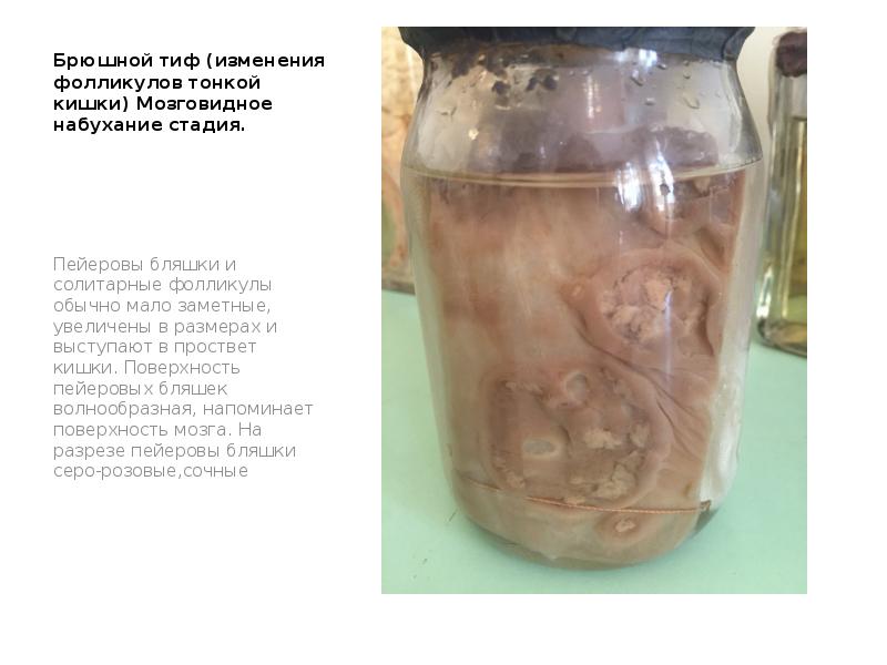 Брюшной тиф (изменения фолликулов тонкой кишки) Мозговидное набухание стадия.
Пейеровы бляшки Брюшной тиф (изменения фолликулов тонкой кишки) Мозговидное набухание стадия.
Пейеровы бляшки