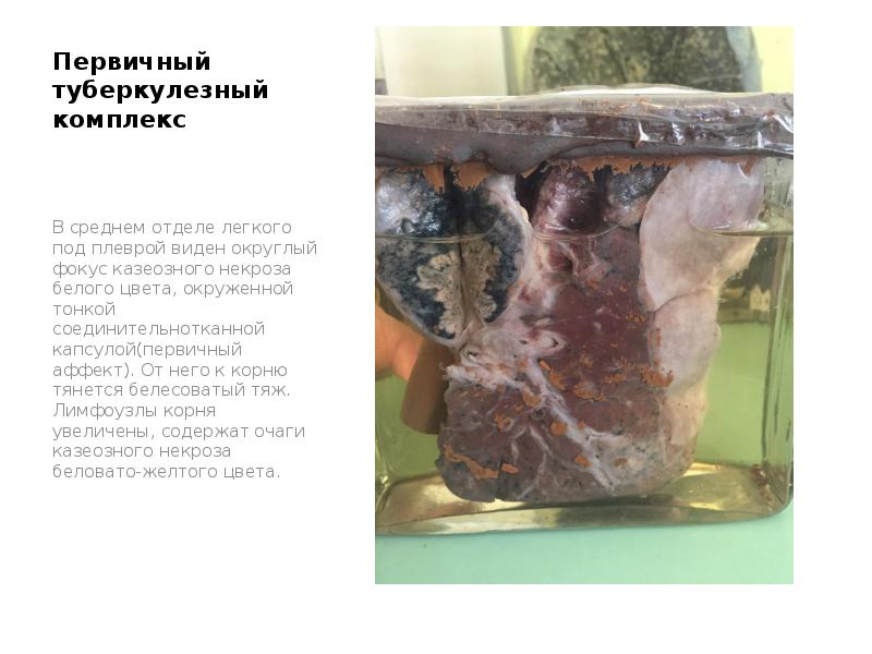 Первичный туберкулезный комплекс
В среднем отделе легкого под плеврой виден округлый Первичный туберкулезный комплекс
В среднем отделе легкого под плеврой виден округлый