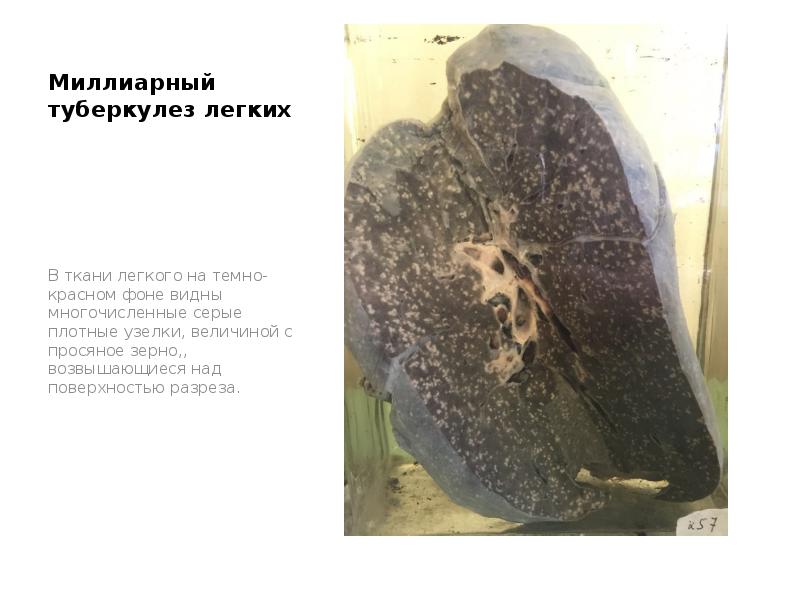 Миллиарный туберкулез легких
В ткани легкого на темно-красном фоне видны многочисленные Миллиарный туберкулез легких
В ткани легкого на темно-красном фоне видны многочисленные