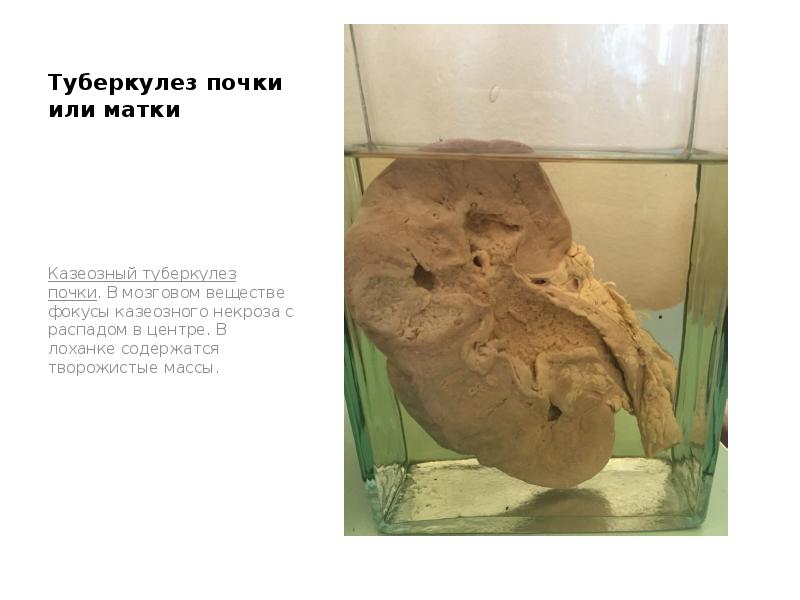 Туберкулез почки или матки
Казеозный туберкулез почки. В мозговом веществе фокусы Туберкулез почки или матки
Казеозный туберкулез почки. В мозговом веществе фокусы