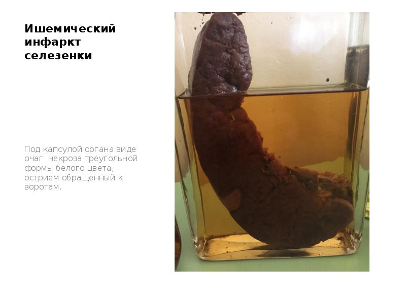 Ишемический инфаркт селезенки
Под капсулой органа виде очаг некроза треугольной формы Ишемический инфаркт селезенки
Под капсулой органа виде очаг некроза треугольной формы