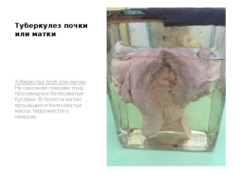 Туберкулез почки или матки
Туберкулез труб или матки. На серозном покрове Туберкулез почки или матки
Туберкулез труб или матки. На серозном покрове