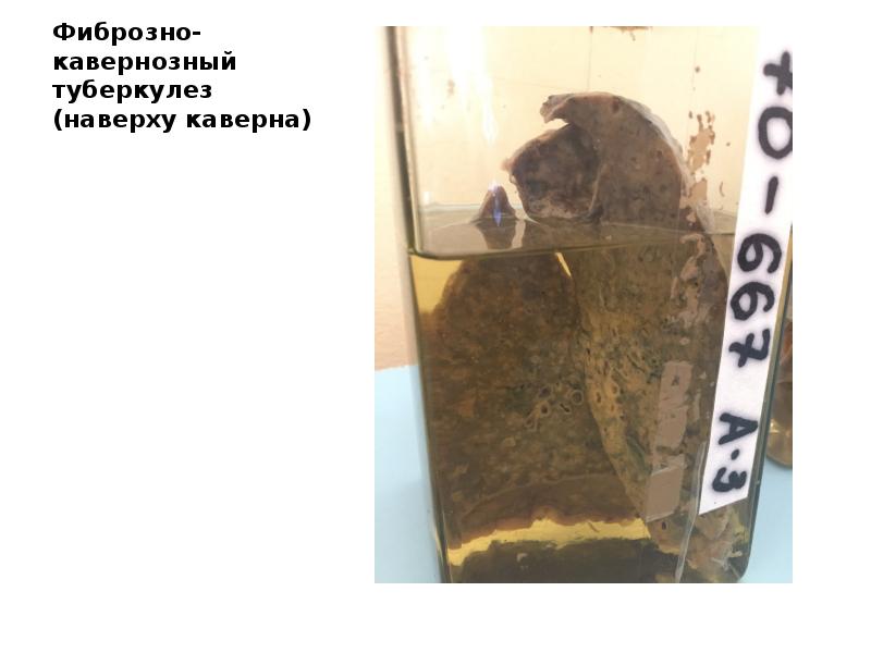 Фиброзно-кавернозный туберкулез (наверху каверна) Фиброзно-кавернозный туберкулез (наверху каверна)