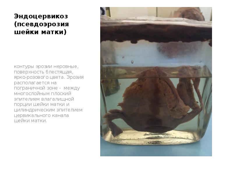 Эндоцервикоз (псевдоэрозия шейки матки)
контуры эрозии неровные, поверхность блестящая, ярко-розового цвета. Эндоцервикоз (псевдоэрозия шейки матки)
контуры эрозии неровные, поверхность блестящая, ярко-розового цвета.