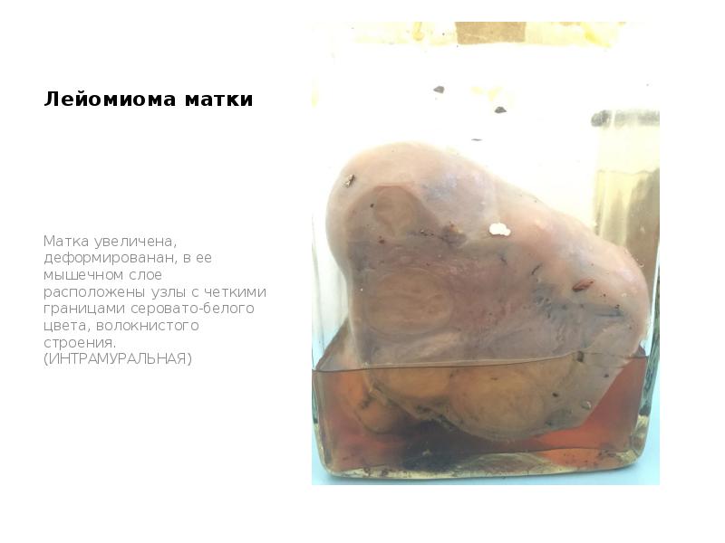 Лейомиома матки
Матка увеличена, деформированан, в ее мышечном слое расположены узлы Лейомиома матки
Матка увеличена, деформированан, в ее мышечном слое расположены узлы