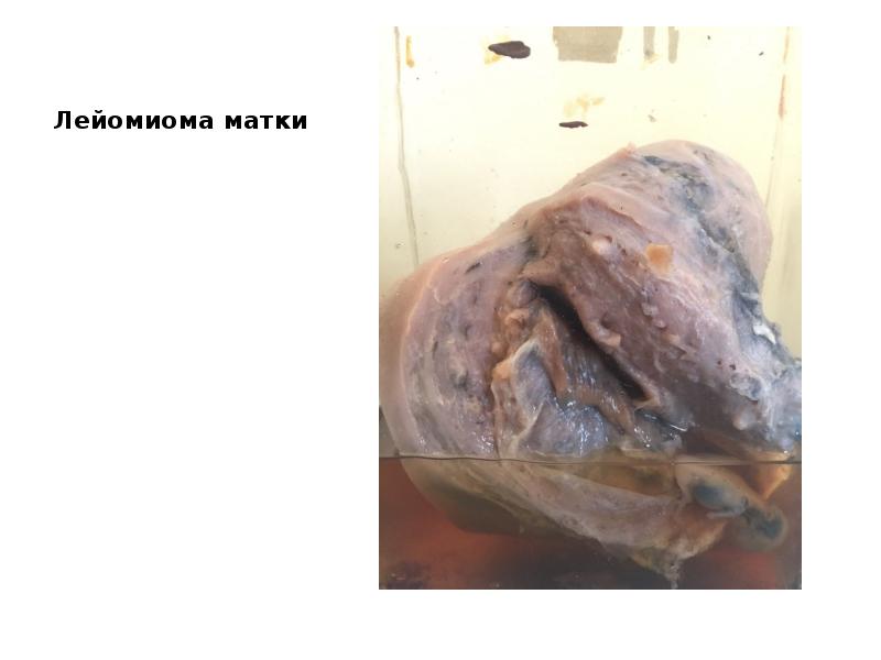 Лейомиома матки Лейомиома матки