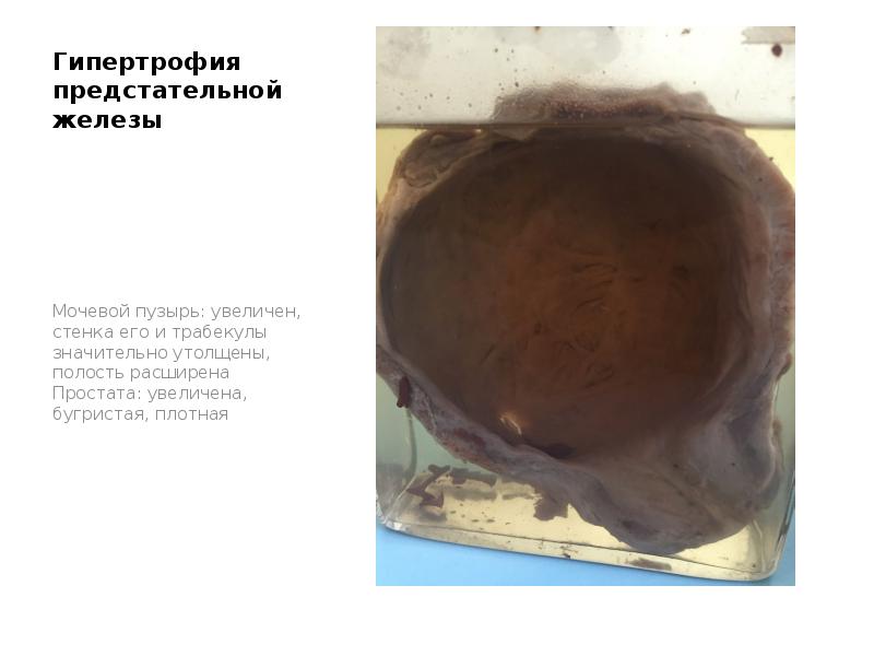 Гипертрофия предстательной железы
Мочевой пузырь: увеличен, стенка его и трабекулы значительно Гипертрофия предстательной железы
Мочевой пузырь: увеличен, стенка его и трабекулы значительно