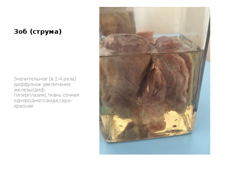 Зоб (струма)
Значительное (в 2-4 раза) диффузное увеличение железы(диф. гиперплазия),ткань сочная Зоб (струма)
Значительное (в 2-4 раза) диффузное увеличение железы(диф. гиперплазия),ткань сочная