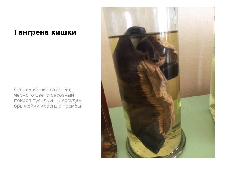 Гангрена кишки
Стенка кишки отечная, черного цвета,серозный покров тусклый. В сосудах Гангрена кишки
Стенка кишки отечная, черного цвета,серозный покров тусклый. В сосудах