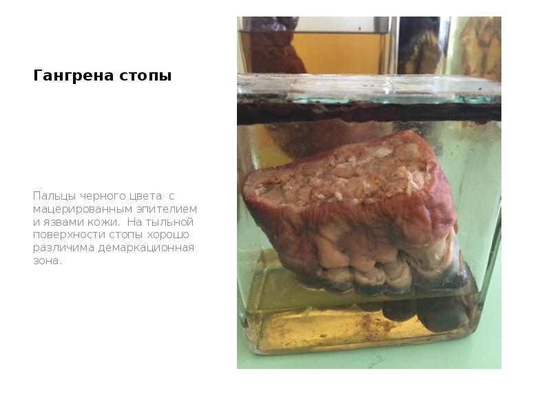 Гангрена стопы
Пальцы черного цвета с мацерированным эпителием и язвами кожи. Гангрена стопы
Пальцы черного цвета с мацерированным эпителием и язвами кожи.