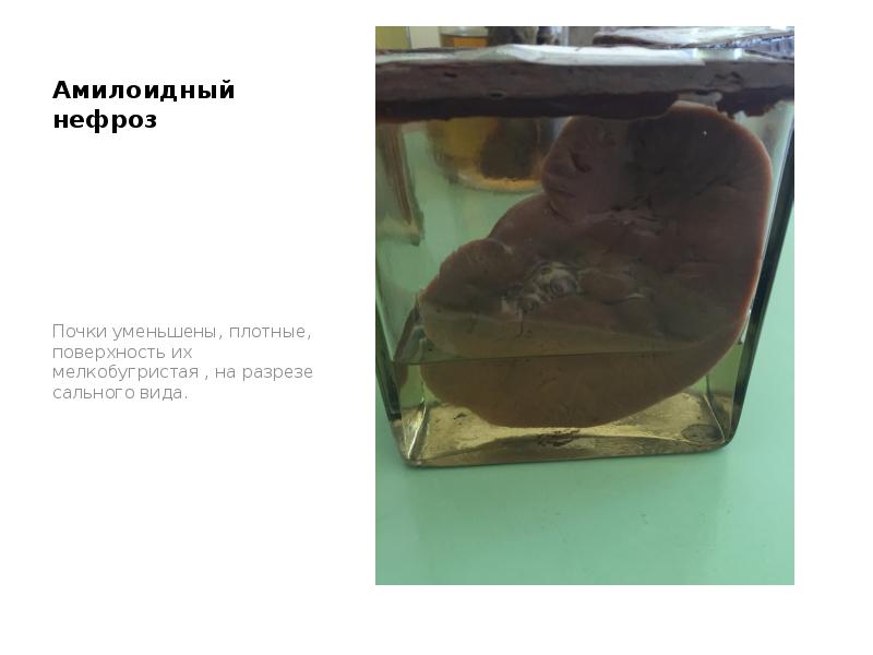 Амилоидный нефроз
Почки уменьшены, плотные, поверхность их мелкобугристая , на разрезе Амилоидный нефроз
Почки уменьшены, плотные, поверхность их мелкобугристая , на разрезе