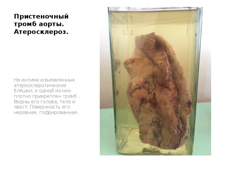 Пристеночный тромб аорты. Атеросклероз.
На интиме изъязвленные атеросклеротические бляшки, к одной Пристеночный тромб аорты. Атеросклероз.
На интиме изъязвленные атеросклеротические бляшки, к одной