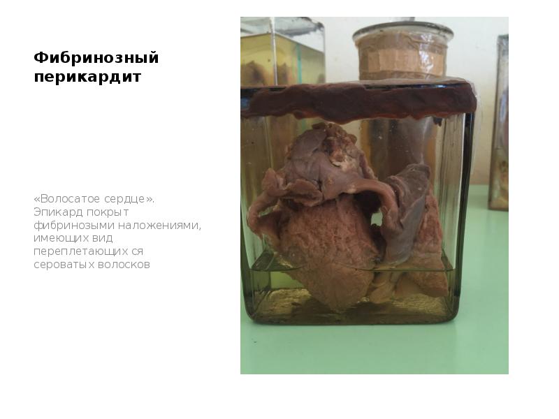 Фибринозный перикардит
«Волосатое сердце». Эпикард покрыт фибринозыми наложениями, имеющих вид переплетающих Фибринозный перикардит
«Волосатое сердце». Эпикард покрыт фибринозыми наложениями, имеющих вид переплетающих