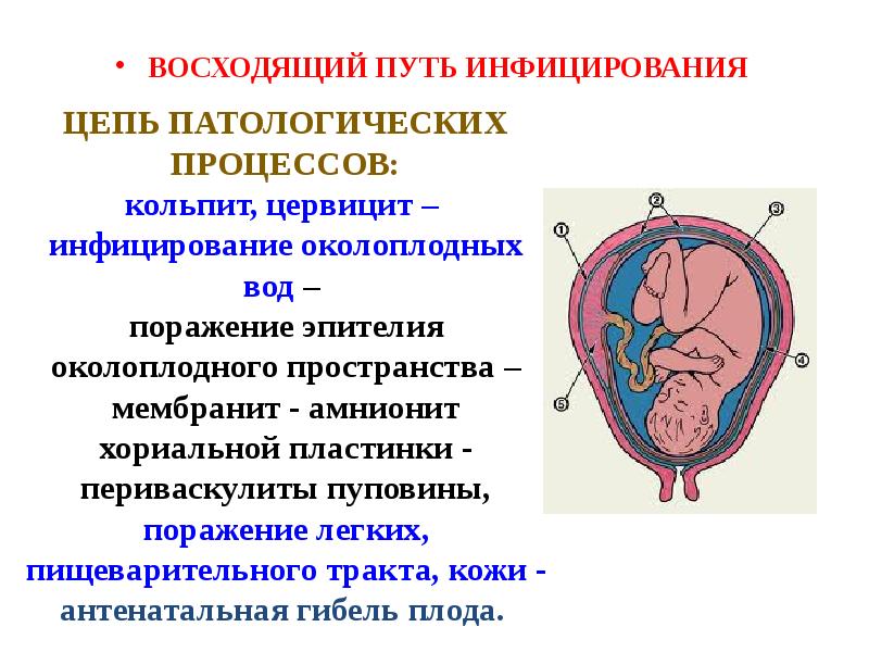 Хориоамнионит. Восходящий путь заражения. Восходящий путь инфицирования плода. Антенатальный восходящий путь инфицирования.