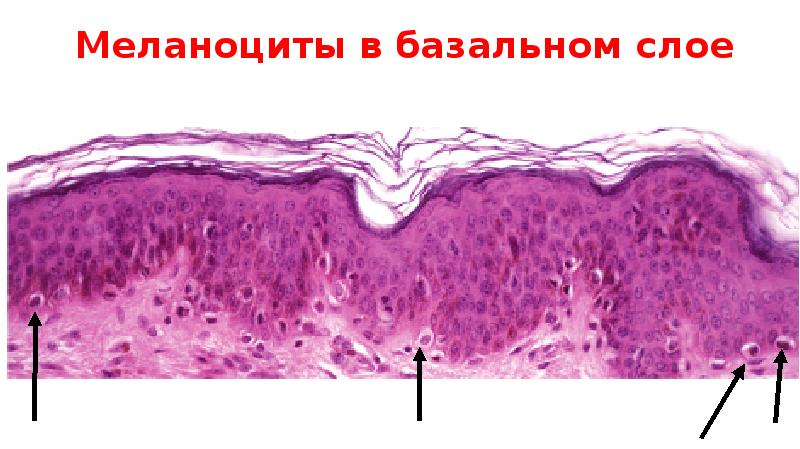 Меланоциты в базальном слое Меланоциты в базальном слое