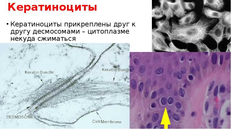Кератиноциты
Кератиноциты прикреплены друг к другу десмосомами – цитоплазме некуда сжиматься Кератиноциты
Кератиноциты прикреплены друг к другу десмосомами – цитоплазме некуда сжиматься