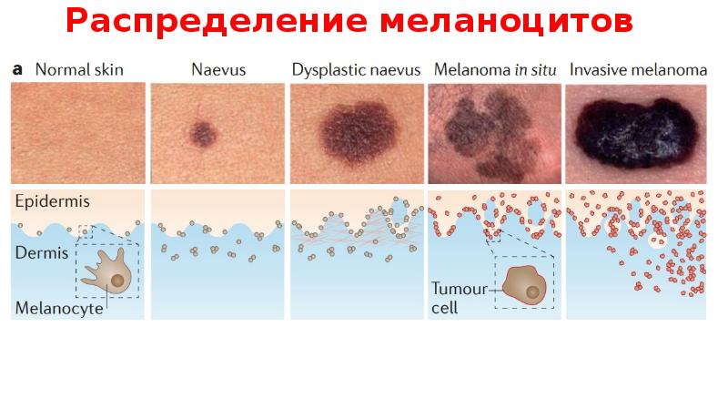 Распределение меланоцитов Распределение меланоцитов