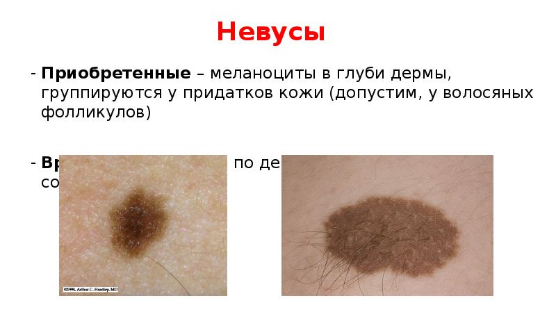 Невусы
Приобретенные – меланоциты в глуби дермы, группируются у придатков кожи Невусы
Приобретенные – меланоциты в глуби дермы, группируются у придатков кожи