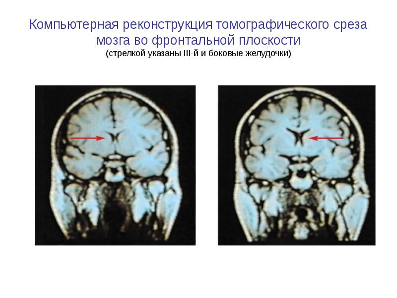 Компьютерная реконструкция томографического среза мозга во фронтальной плоскости (стрелкой указаны III-й