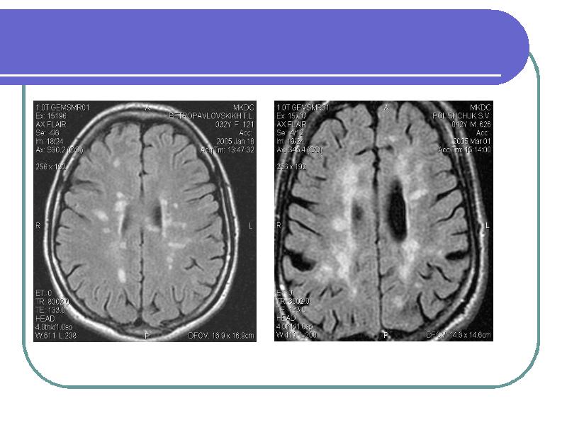 Мр картина демиелинизирующего заболевания головного мозга