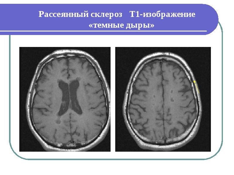 Мр картина демиелинизирующего заболевания головного мозга