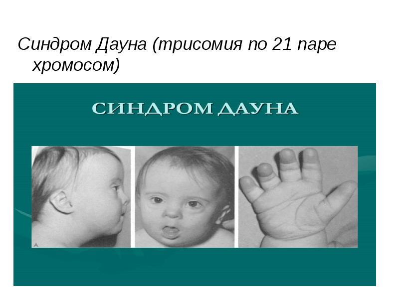 Ген дауна. Синдром Дауна трисомия 21 хромосомы. Синдром Дауна трисомия по 21 хромосоме. Синдром Дауна трисомия по 21 паре. Синдром Дауна Тип наследования.