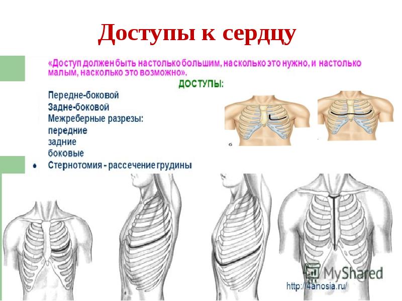 Операции на грудной стенке