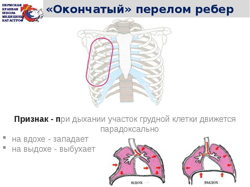 Признаки перелома ребер. Симптомы при переломе ребра. Симптомы перелома ребра грудной клетки. Признаки закрытого перелома ребер. Перелом ребра с левой стороны сзади.