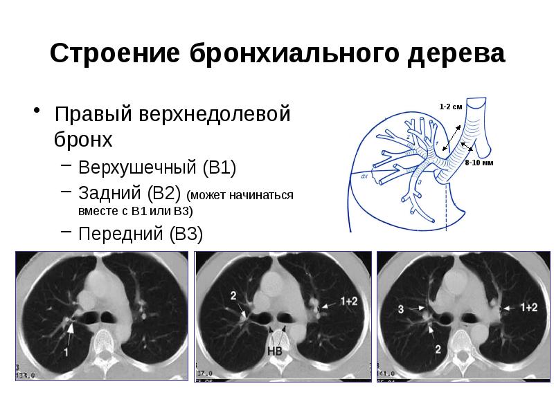 Бронхи на кт схема