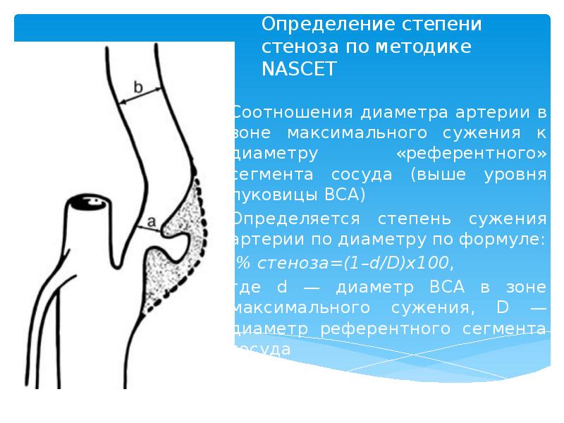 Процент стеноза сосудов. Стеноз по nascet. Степень стеноза артерий по nascet. Степень стеноза по методике nascet. Степени стеноза ВСА по nascet.