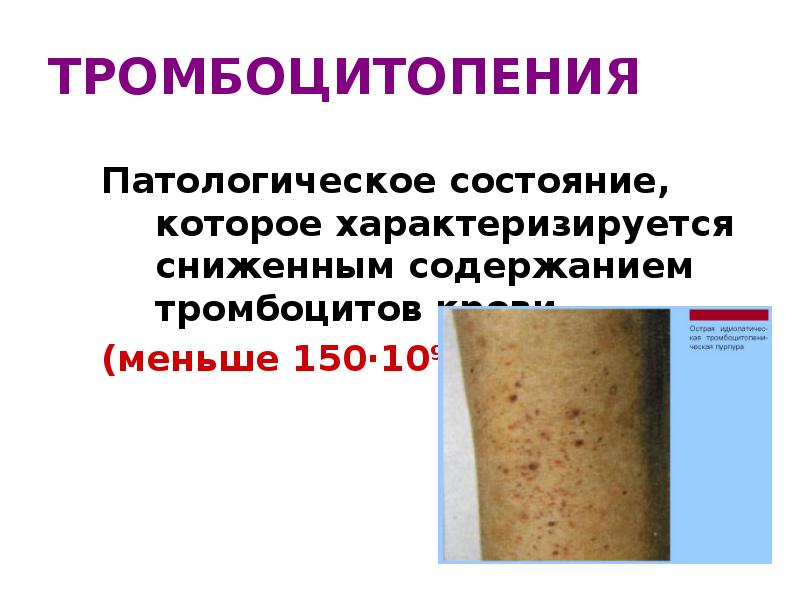 ТРОМБОЦИТОПЕНИЯ
Патологическое состояние, которое характеризируется сниженным содержанием тромбоцитов крови
(меньше 150·109 ТРОМБОЦИТОПЕНИЯ
Патологическое состояние, которое характеризируется сниженным содержанием тромбоцитов крови
(меньше 150·109