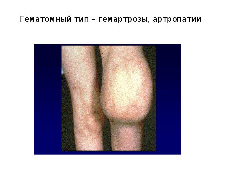 Гематомный тип – гемартрозы, артропатии Гематомный тип – гемартрозы, артропатии