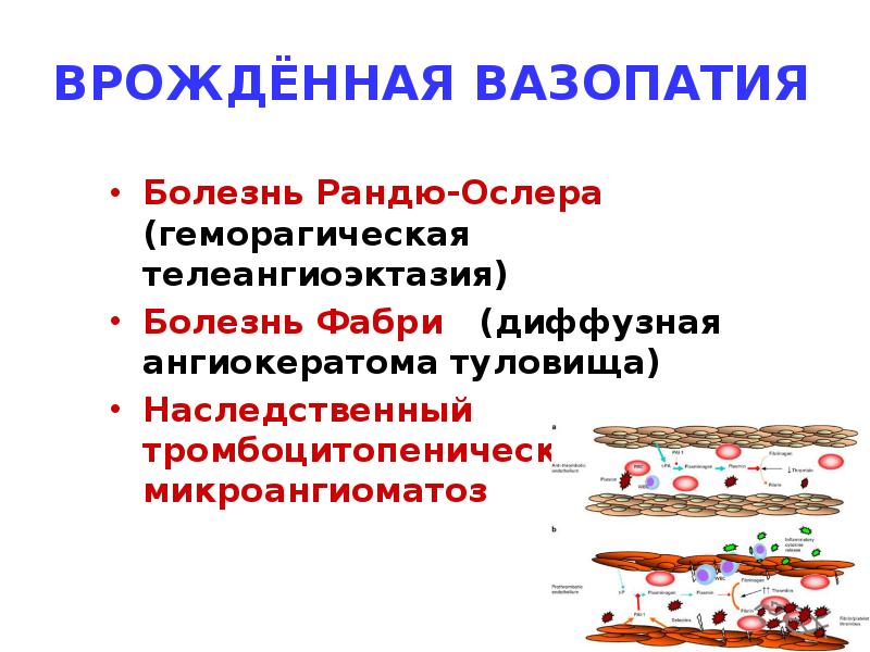 ВРОЖДЁННАЯ ВАЗОПАТИЯ
Болезнь Рандю-Ослера (геморагическая телеангиоэктазия)
Болезнь Фабри (диффузная ВРОЖДЁННАЯ ВАЗОПАТИЯ
Болезнь Рандю-Ослера (геморагическая телеангиоэктазия)
Болезнь Фабри (диффузная