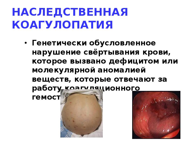 НАСЛЕДСТВЕННАЯ КОАГУЛОПАТИЯ
Генетически обусловленное нарушение свёртывания крови, которое вызвано дефицитом или НАСЛЕДСТВЕННАЯ КОАГУЛОПАТИЯ
Генетически обусловленное нарушение свёртывания крови, которое вызвано дефицитом или