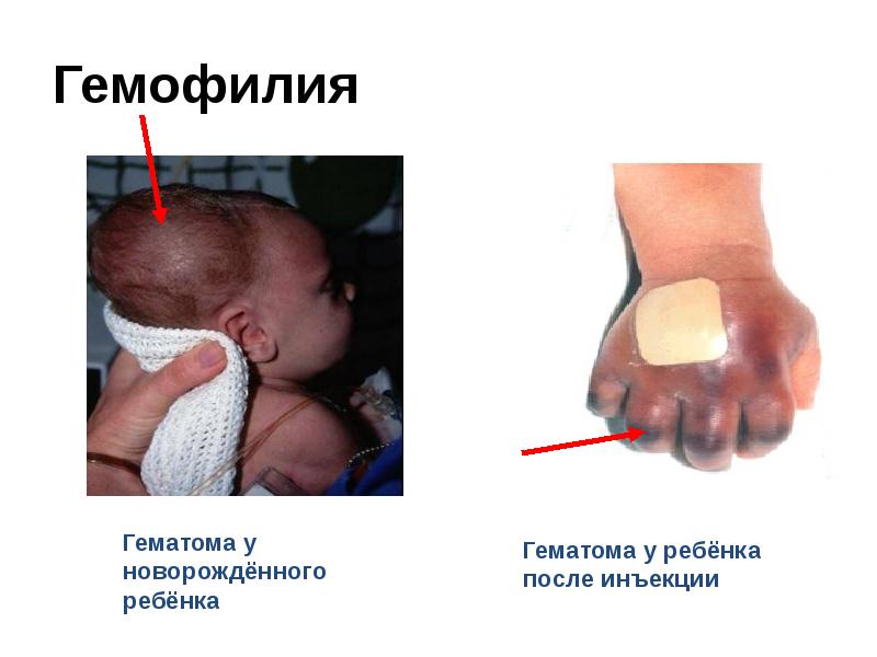 Гемофилия Гемофилия