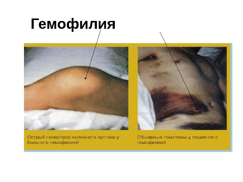 Гемофилия Гемофилия