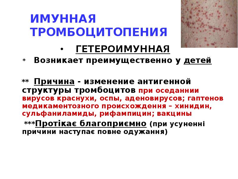 ИМУННАЯ ТРОМБОЦИТОПЕНИЯ
ГЕТЕРОИМУННАЯ
* Возникает преимущественно у детей
ИМУННАЯ ТРОМБОЦИТОПЕНИЯ
ГЕТЕРОИМУННАЯ
* Возникает преимущественно у детей