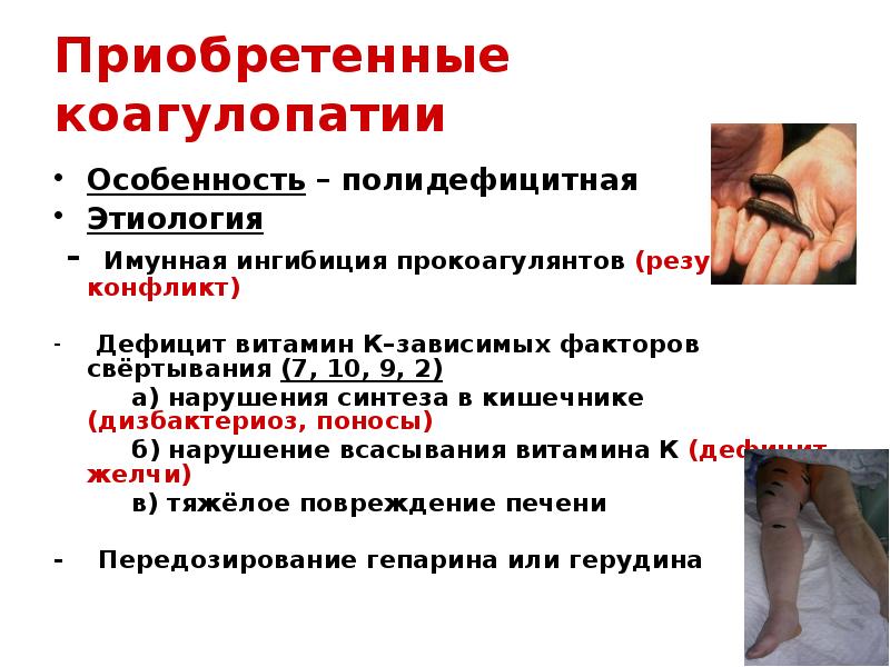 Приобретенные коагулопатии
Особенность – полидефицитная
Этиология
- Имунная ингибиция Приобретенные коагулопатии
Особенность – полидефицитная
Этиология
- Имунная ингибиция