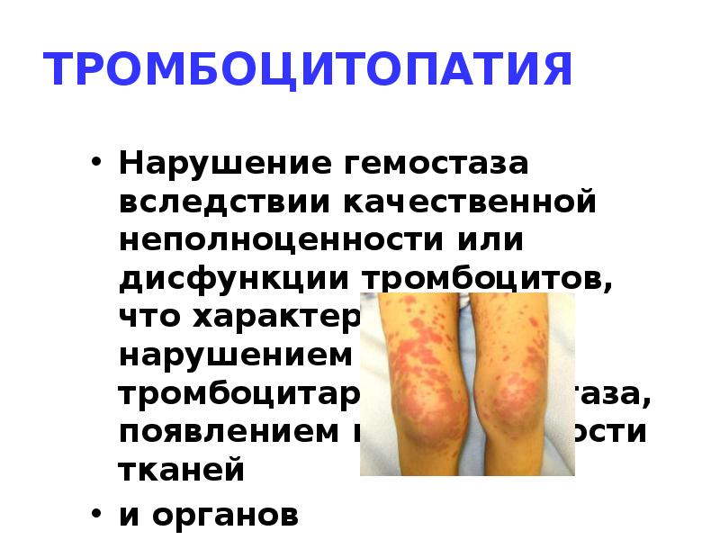 ТРОМБОЦИТОПАТИЯ
Нарушение гемостаза вследствии качественной неполноценности или дисфункции тромбоцитов, что характеризтруется ТРОМБОЦИТОПАТИЯ
Нарушение гемостаза вследствии качественной неполноценности или дисфункции тромбоцитов, что характеризтруется