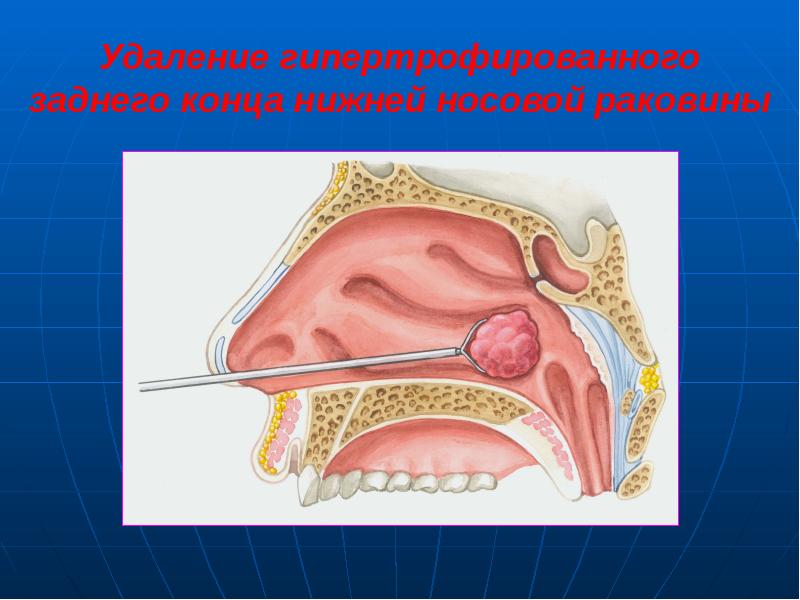 Острый ринит презентация