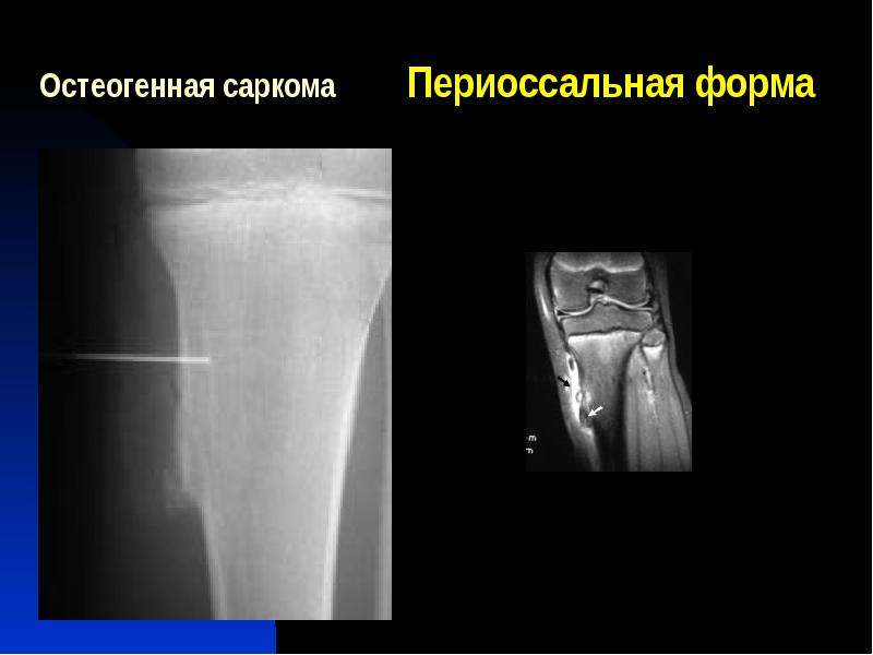 Саркомы мягких тканей презентация